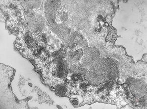 M,58y. | membranous glomerulopathy -early stage